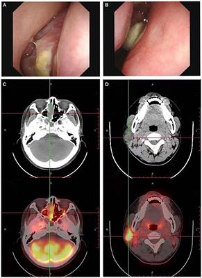 Persistent pain and numbness in the extremities of an adult due to paraneoplastic peripheral neuropathy caused by olfactory neuroblastoma: A case report